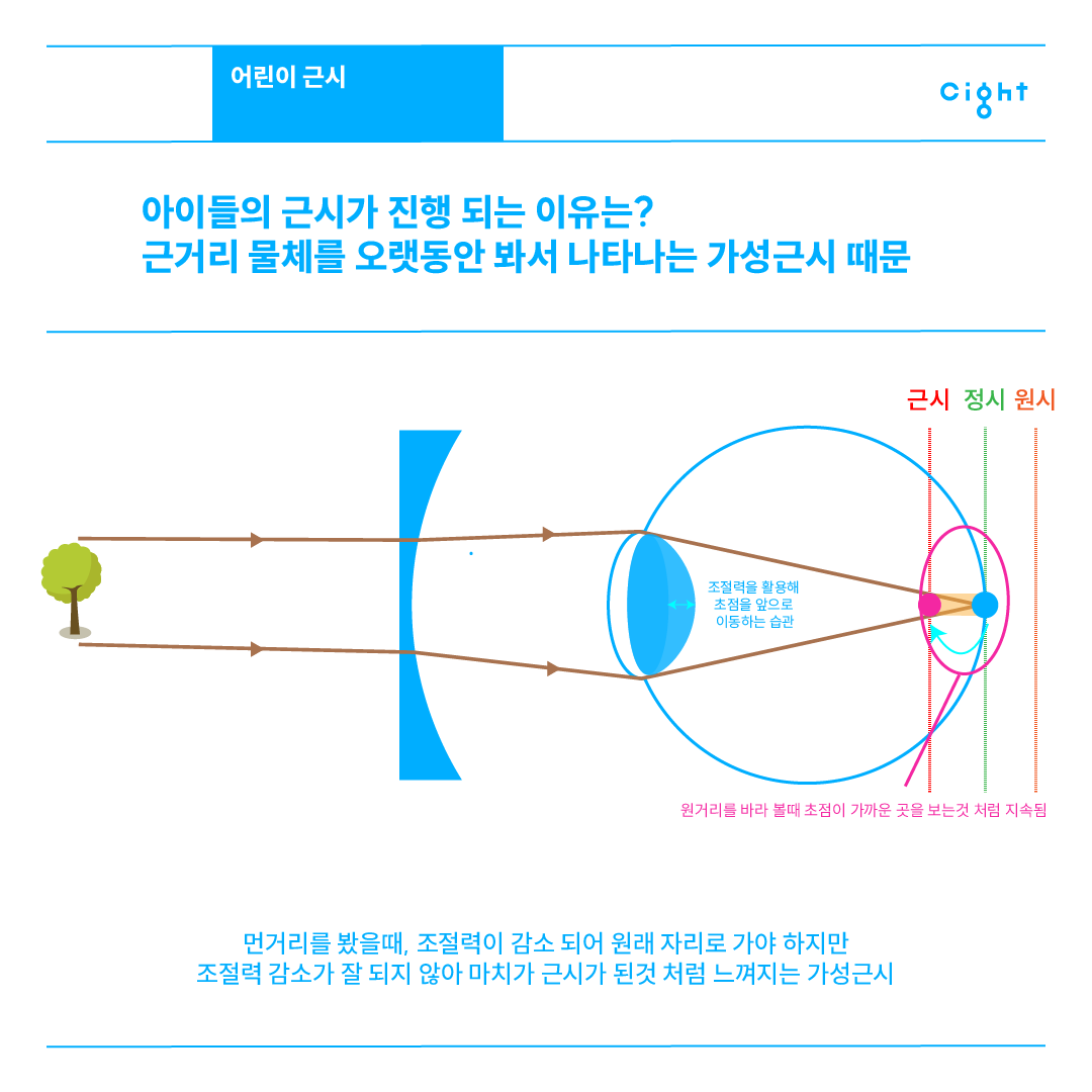 가성근시 원리 - 조절력에 의한 초점 이동 도해