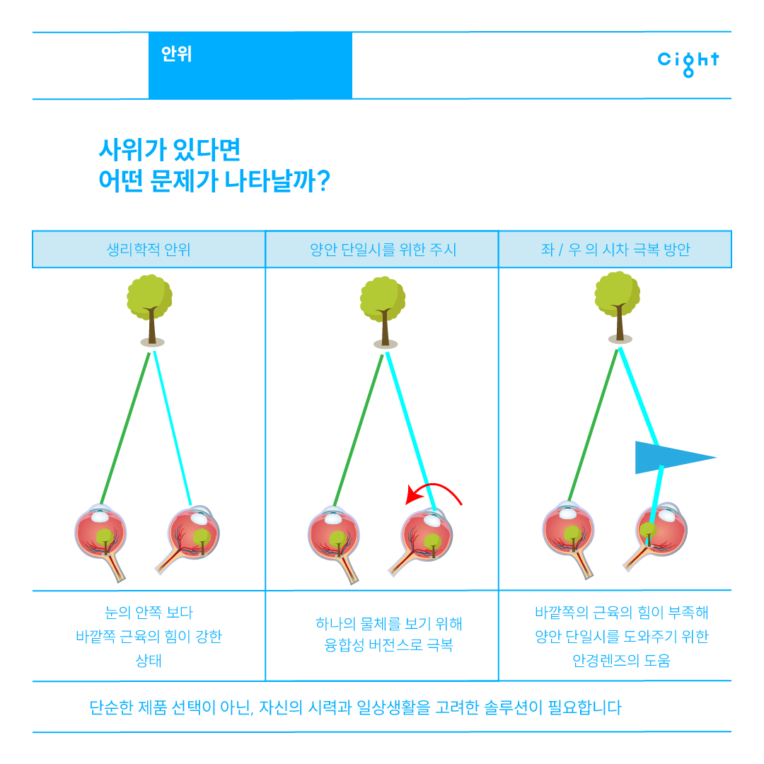 사위 문제 발생 원리와 프리즘 안경렌즈 교정 도해