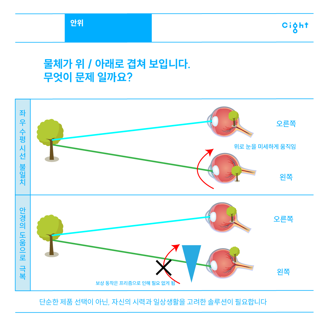 수직 시선 불일치와 프리즘 교정 원리